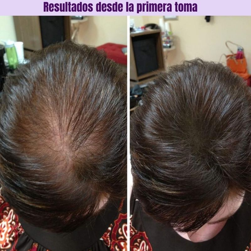 HairGrowth™: Suplemento para el crecimiento capilar avanzado